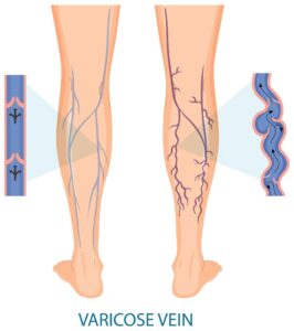 Varicose Veins Treatment
