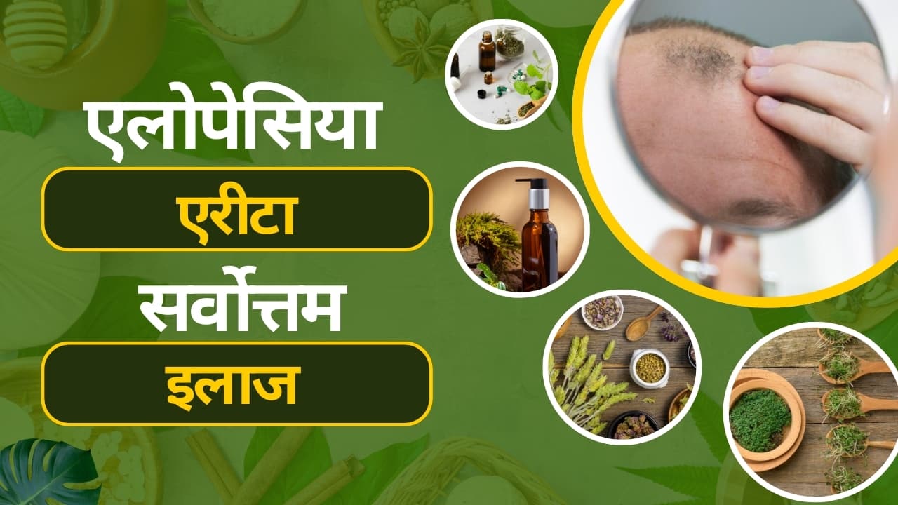 एलोपेसिया एरीटा ट्रीटमेंट: सर्वोत्तम एलोपेसिया एरीटा का इलाज, Alopecia Areata Treatment in Hindi
