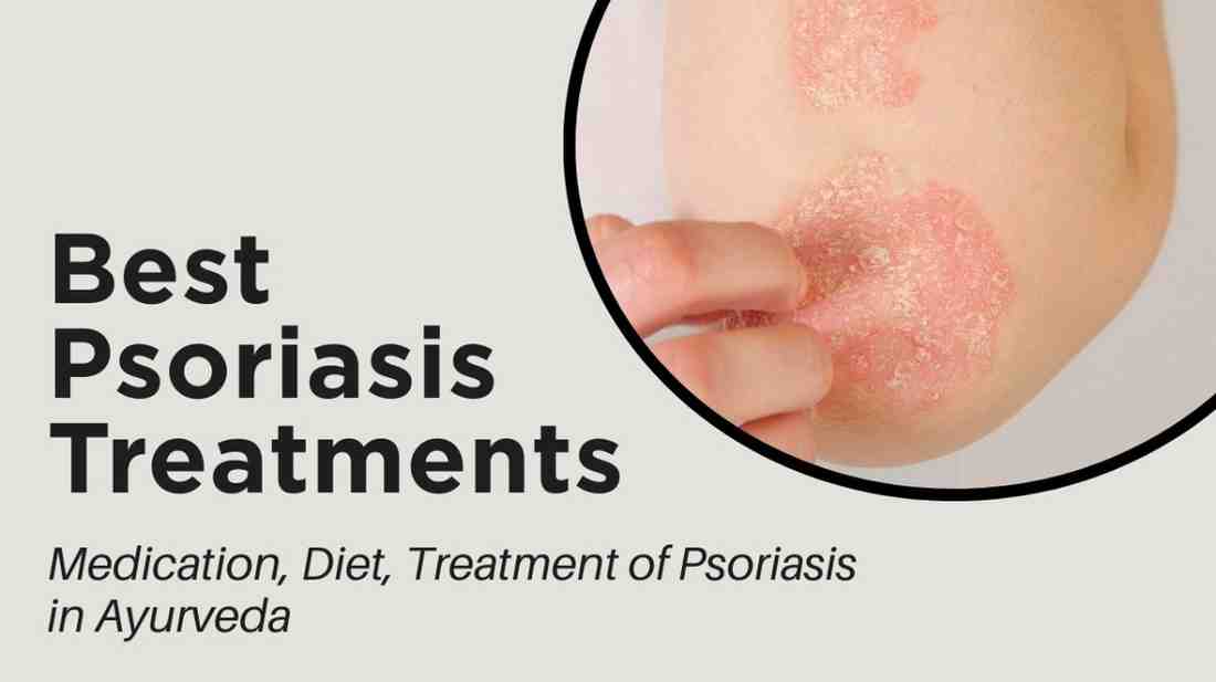 Best Psoriasis Treatments – Medication, Diet, Treatment of Psoriasis in Ayurveda