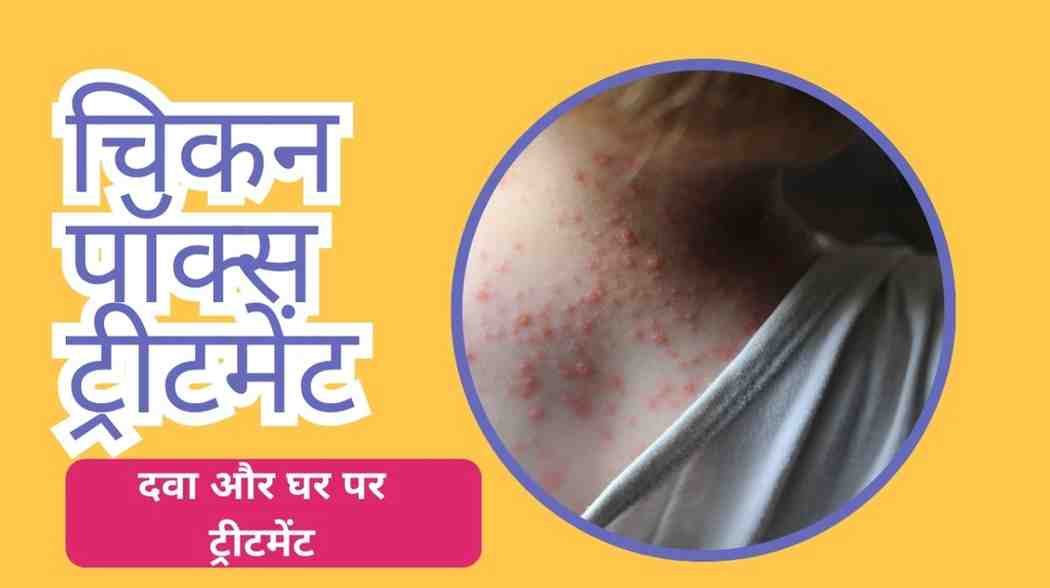 चिकन पॉक्स ट्रीटमेंट – दवा और घर पर ट्रीटमेंट, Chicken Pox Treatment in Hindi