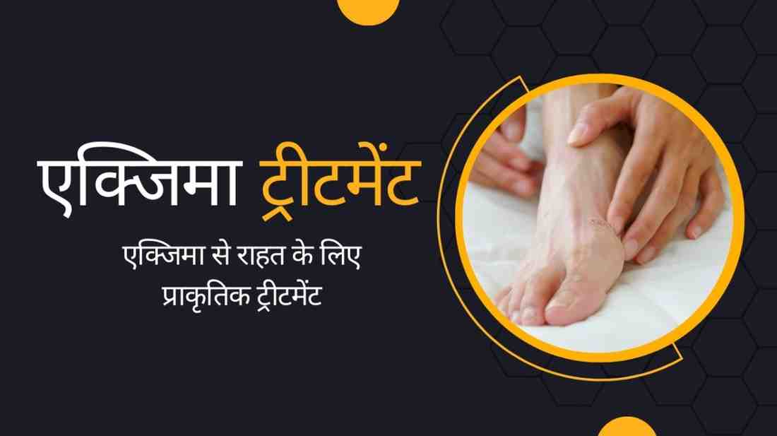 एक्जिमा ट्रीटमेंट : एक्जिमा से राहत के लिए प्राकृतिक ट्रीटमेंट, Eczema Treatment in Hindi