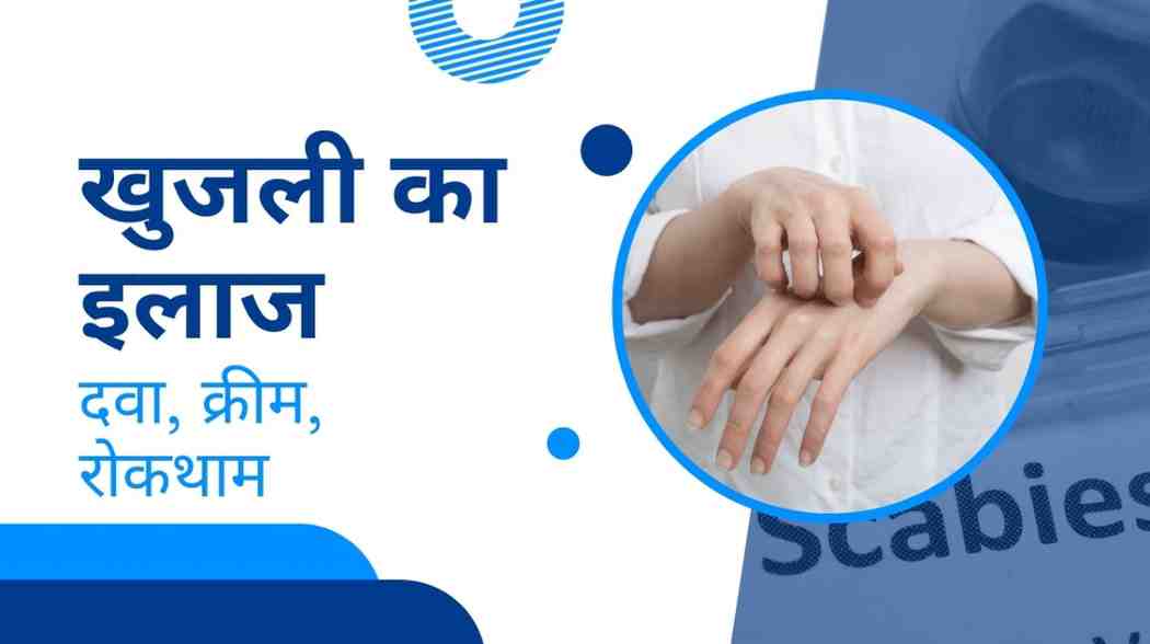 खुजली का इलाज: दवा, क्रीम, रोकथाम, Scabies Treatment in Hindi