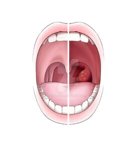 Tonsillitis Treatment in Hindi