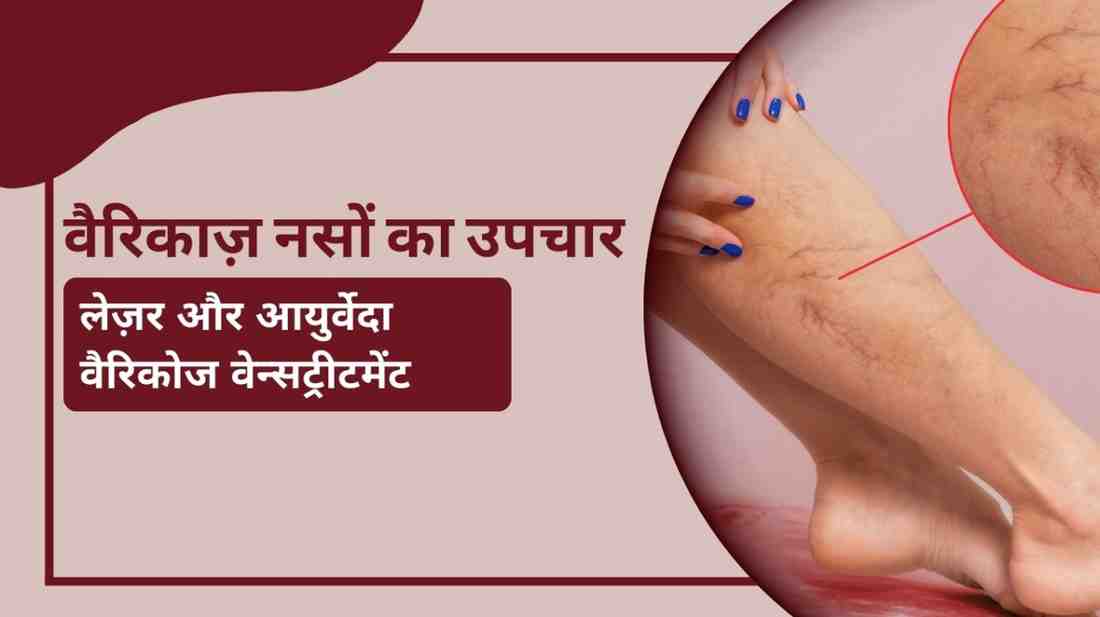 वैरिकाज़ नसों का उपचार – लेज़र और आयुर्वेदा वैरिकोज वेन्सट्रीटमेंट, Varicose Veins Treatment in Hindi