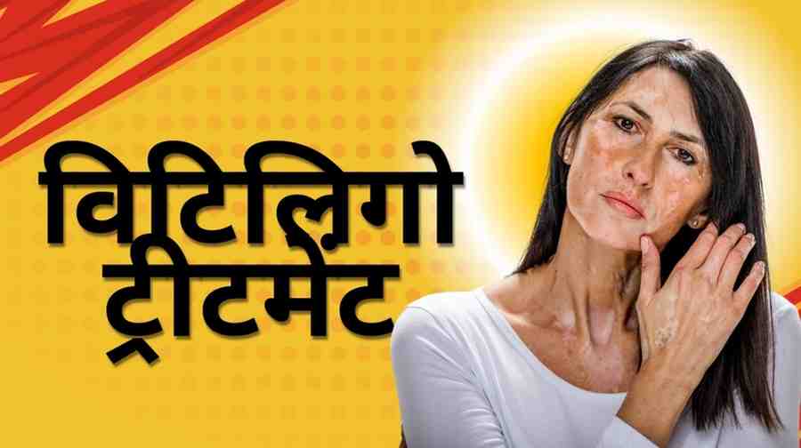 विटिलिगो ट्रीटमेंट निदान, ट्रीटमेंट और पुनर्प्राप्ति, Vitiligo Treatment in Hindi