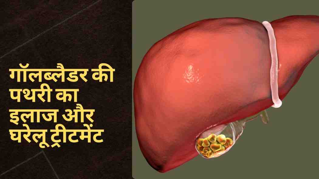 गॉलब्लैडर की पथरी का इलाज और घरेलू ट्रीटमेंट, Gallbladder Stones Treatment in Hindi