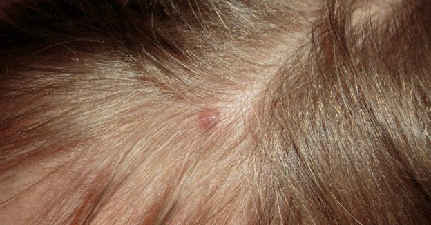 Pimple Treatment