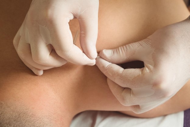 Acupuncture Treatment