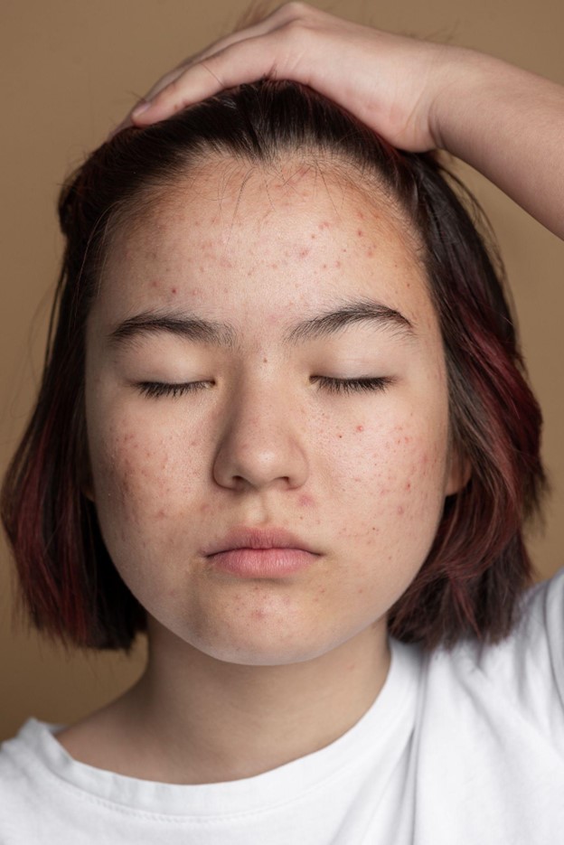 How to Remove Black Spots on Face