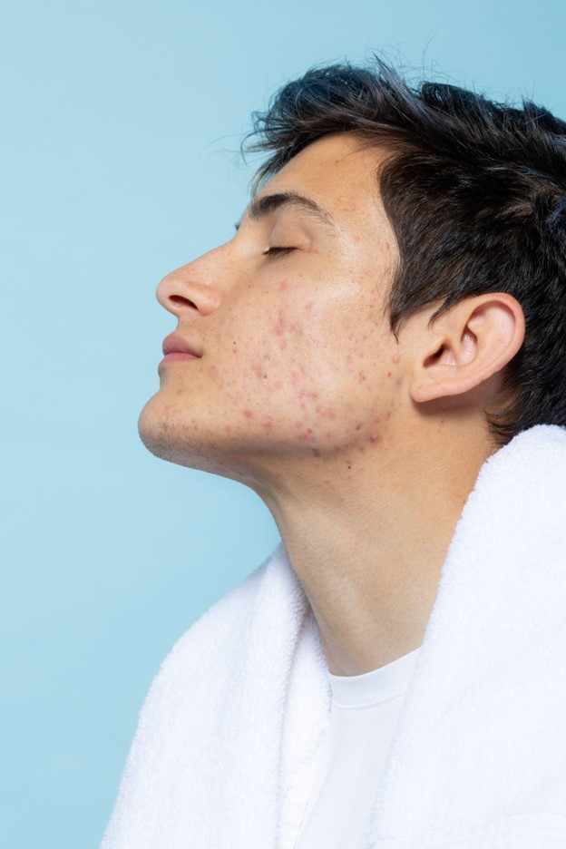 Pimple Treatment