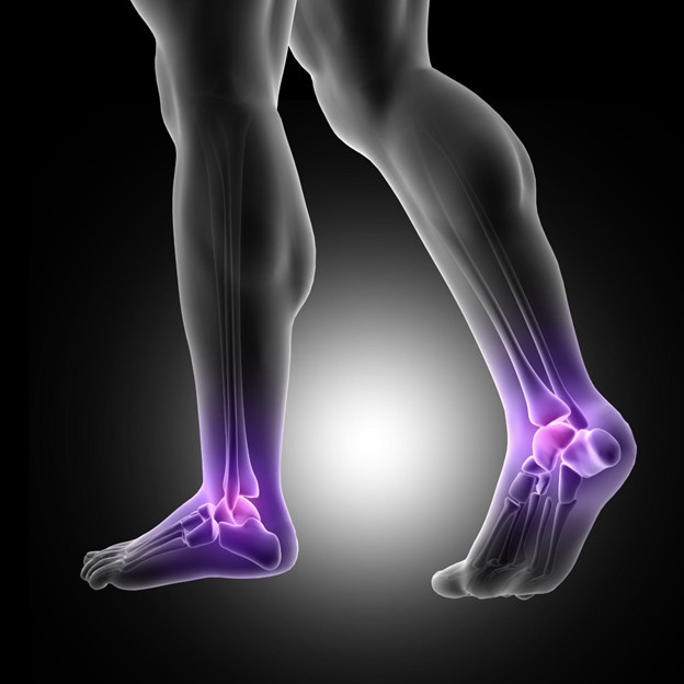 Plantar Fasciitis image