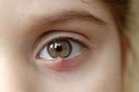 Stye Treatment