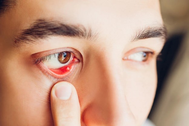 Stye Treatment