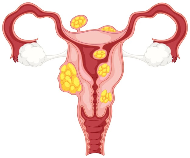 Uterine Fibroids Treatment