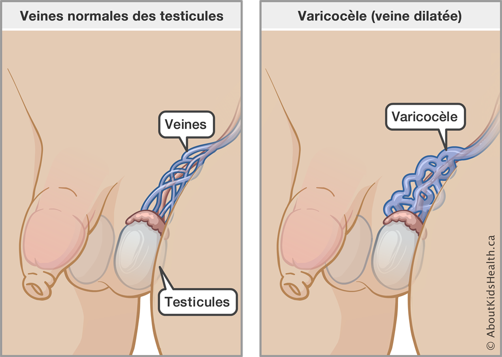 Varicocele Treatment