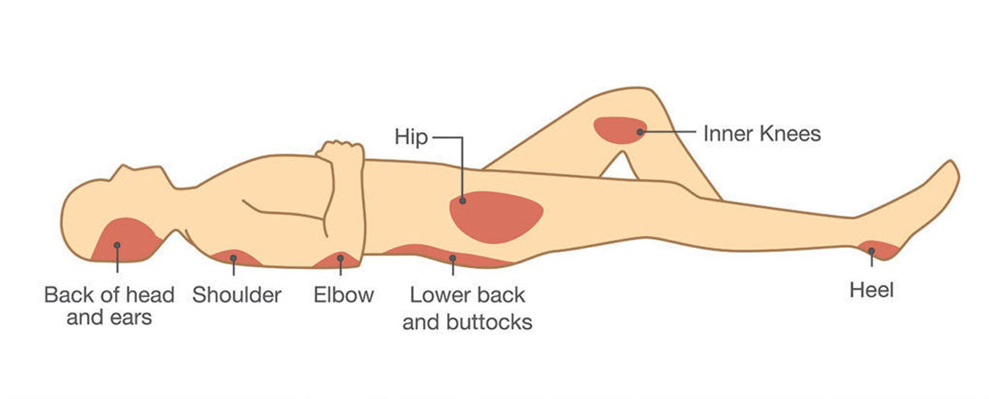 Bed Sores Treatment