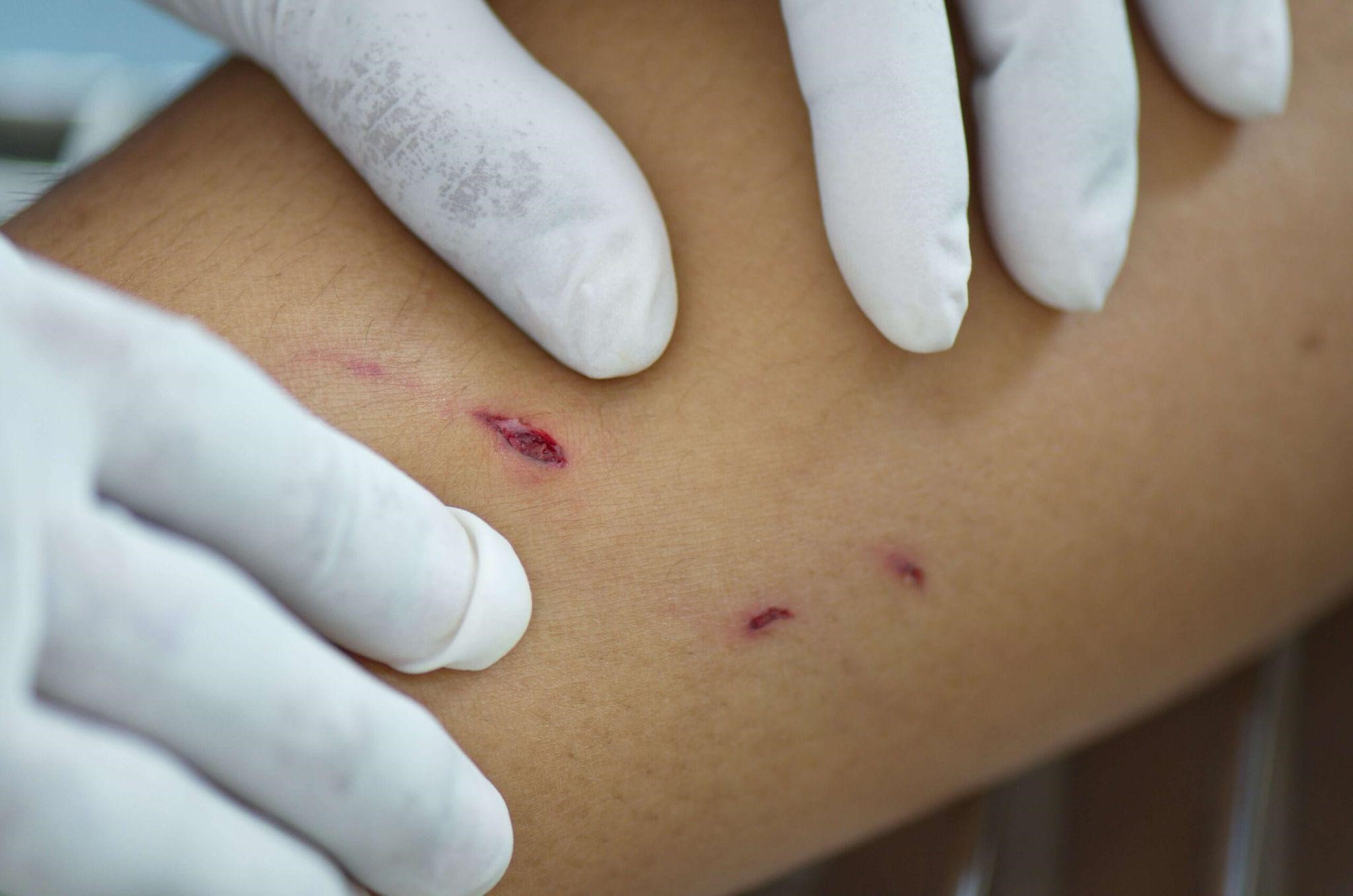 Dog Bite Treatment