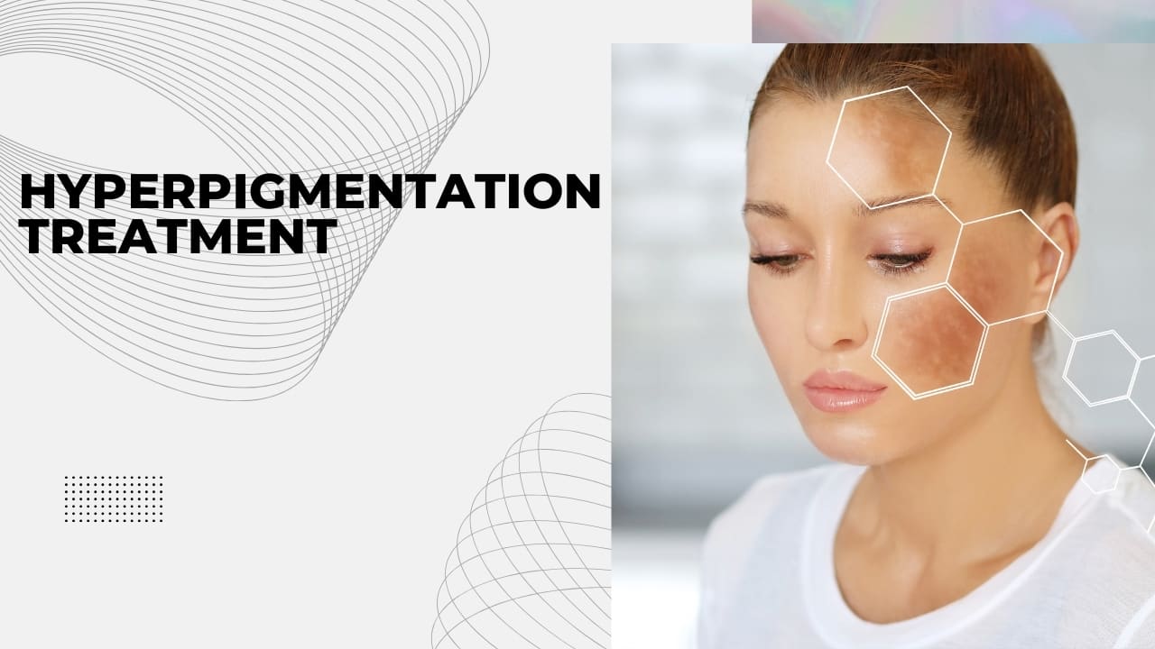 Hyperpigmentation Treatment – Best Treatment for Hyperpigmentation