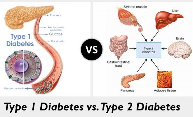 type 1 vs type 2 diabetes