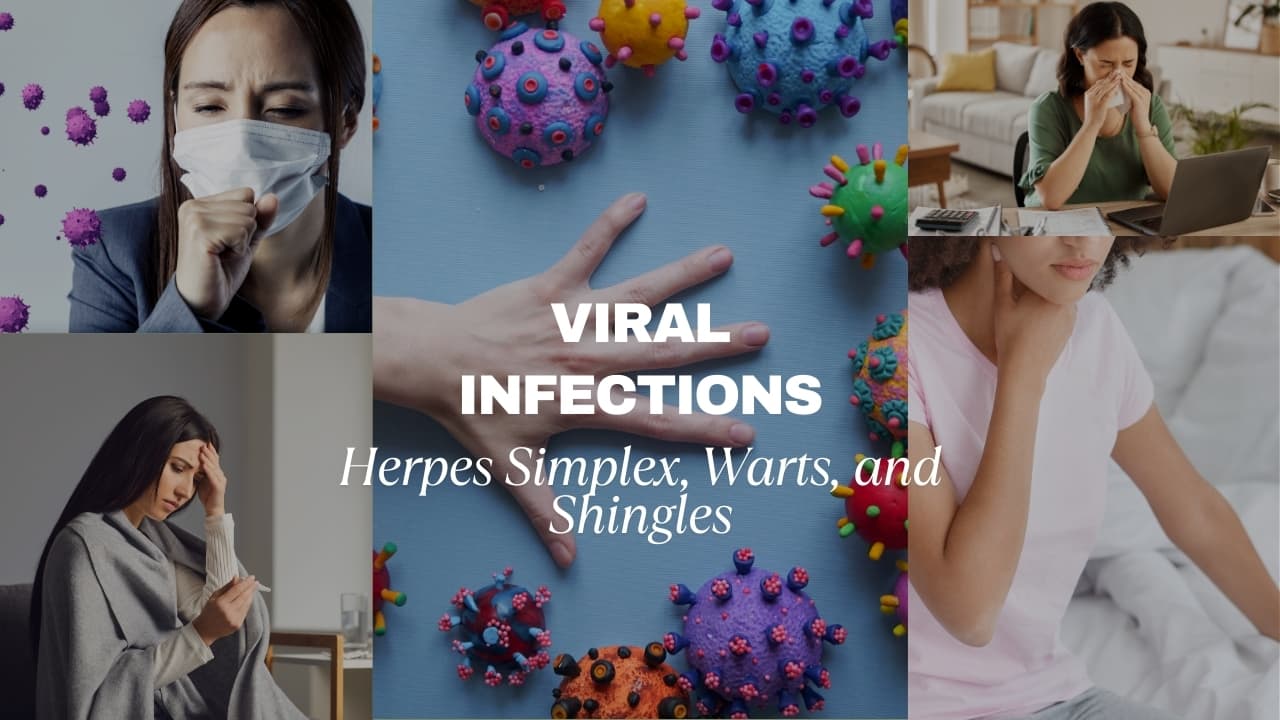 Viral Infections : Herpes Simplex, Warts, and Shingles