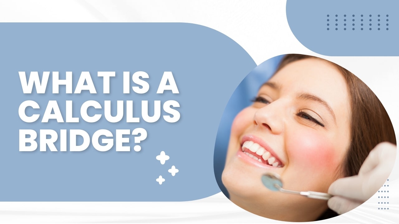 What is a Calculus Bridge? A Simple Explanation