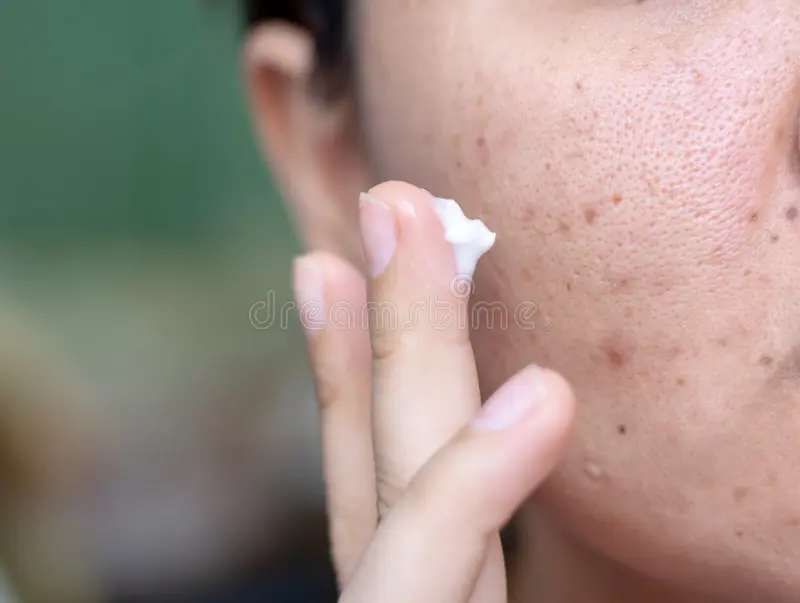 Mederma Cream: Skin Benefits and Possible Side Effects